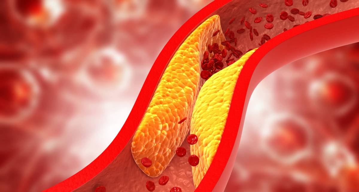 Cholesterol: Fakty i Mity